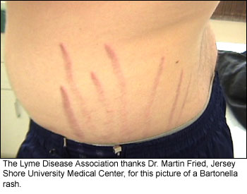 Photo_Rash_113 bartonella rash