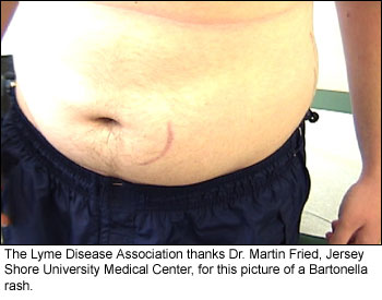 Photo_Rash_116 bartonella 4