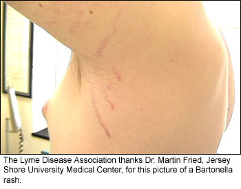 Photo_Rash_117 bartonella 5