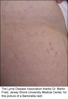Photo_Rash_118 bartonella 6