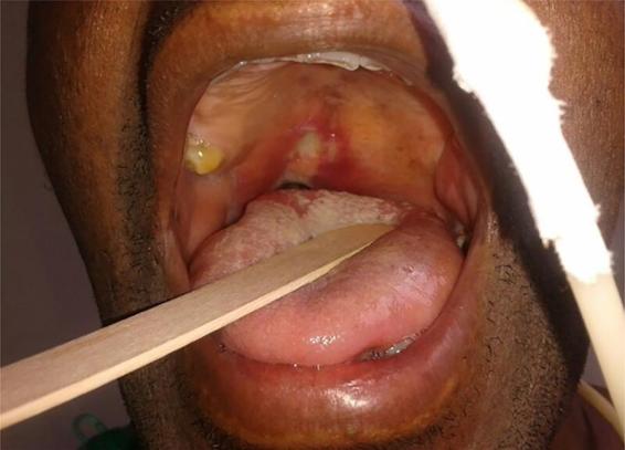 bacillary angiomatosis