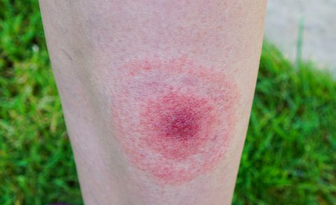 lyme-disease-bulls-eye-1524676364
