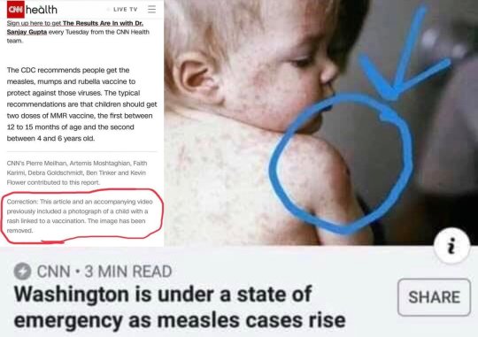 Measles