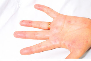 Janeway lesion Pictures, Definition, Symptoms, Causes, Treatment