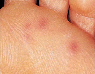 Janeway lesion Pictures, Definition, Symptoms, Causes, Treatment