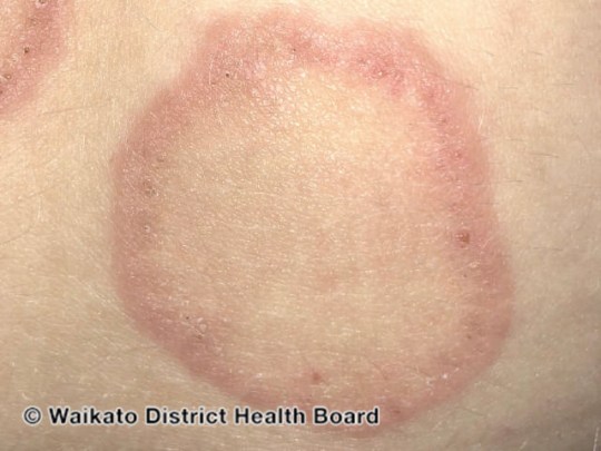 annular-erythema-03__WatermarkedWyJXYXRlcm1hcmtlZCJd