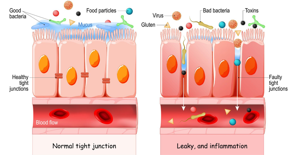 Leaky_Gut_Syndrome_feature