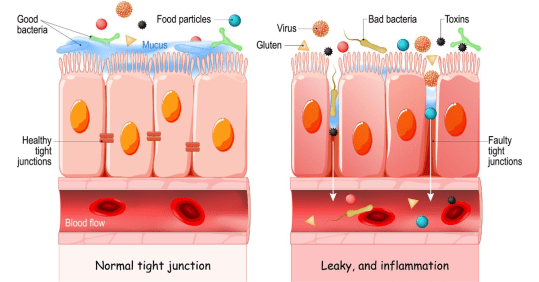 Leaky_Gut_Syndrome_feature